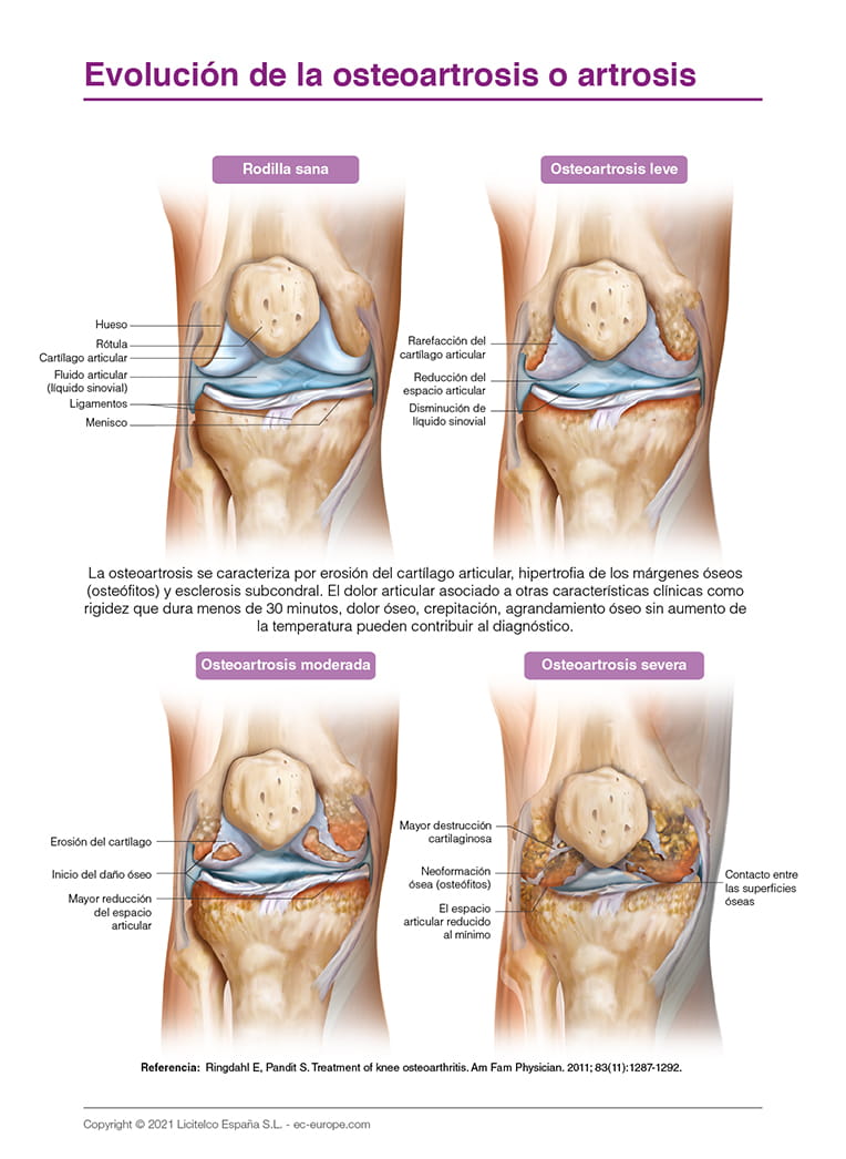 Evolución de la osteoartrosis o artrosis