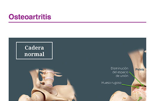 Osteoartritis