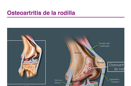 Osteoartrosis de la rodilla