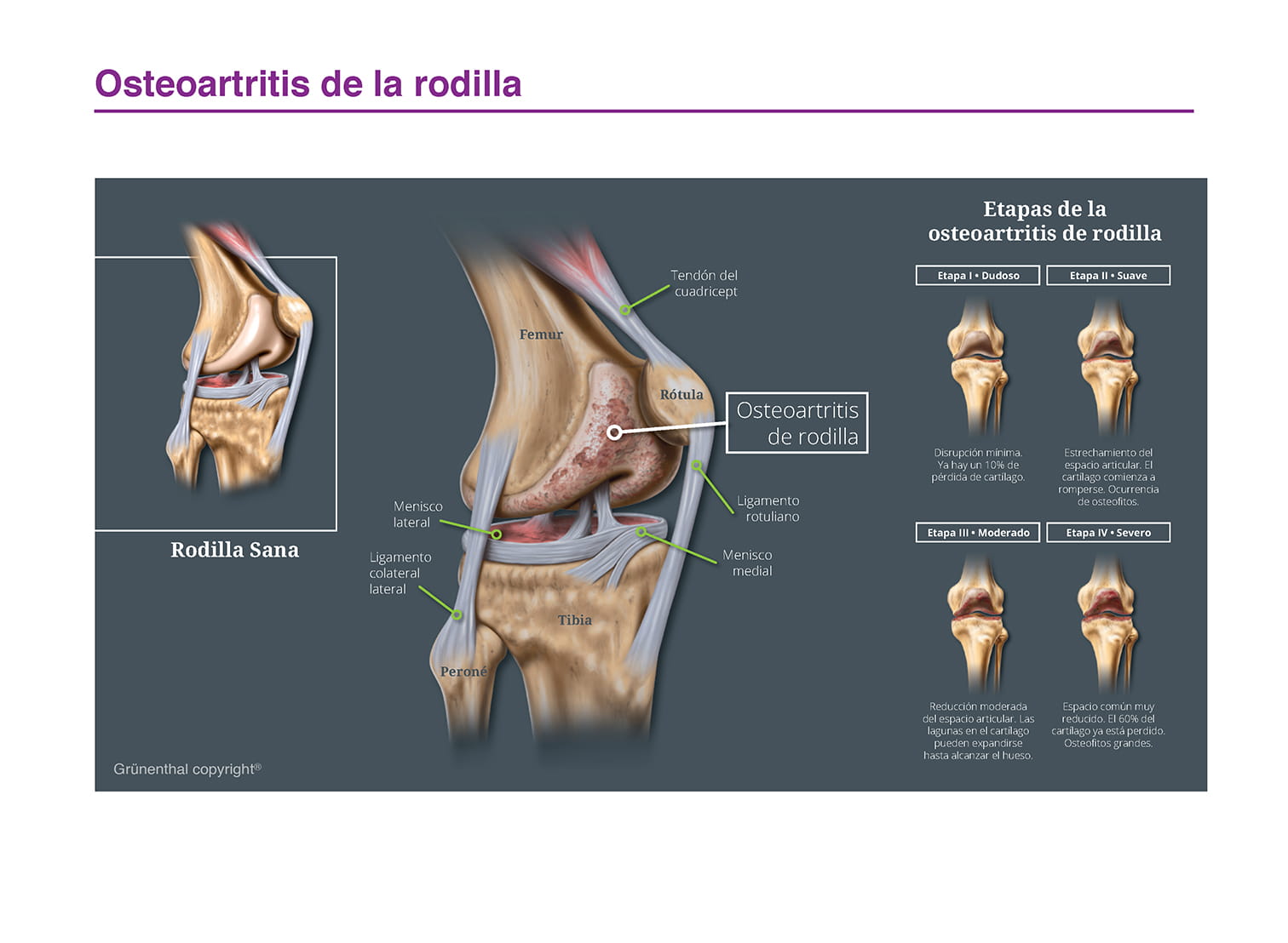 Osteoartrosis de la rodilla