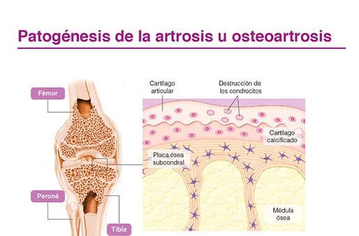 Patogénesis de la artrosis u osteoartrosis