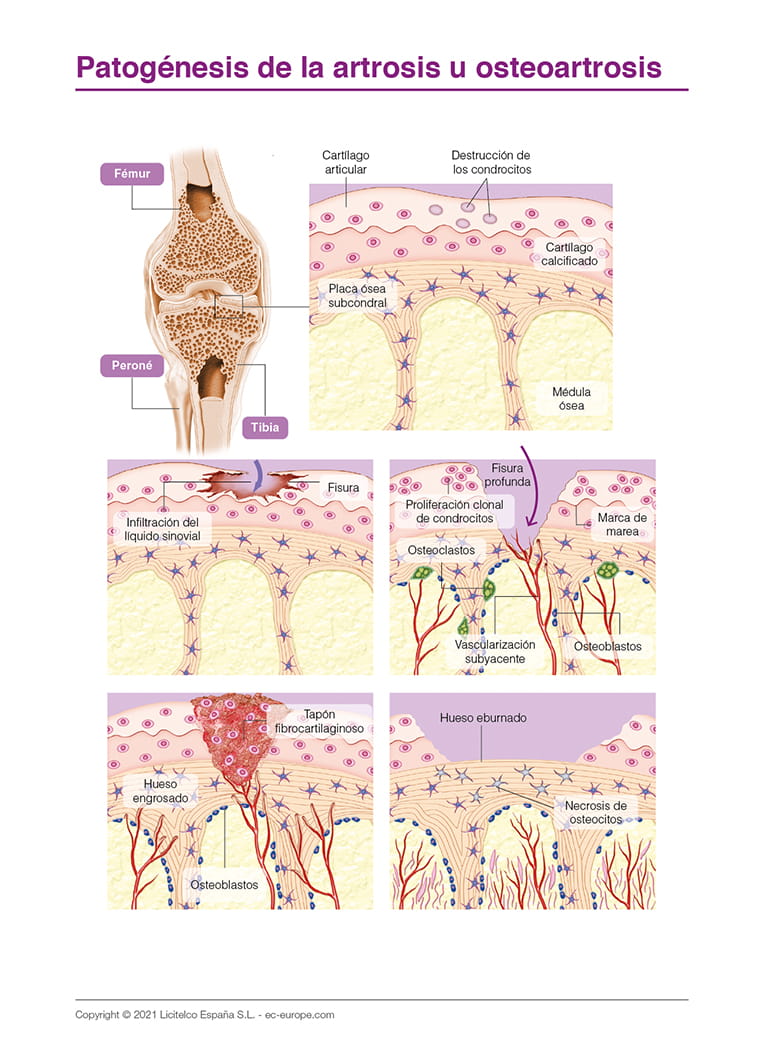 Patogénesis de la artrosis u osteoartrosis