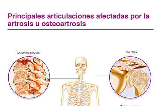 Principales articulaciones afectadas por la artrosis u osteoartrosis