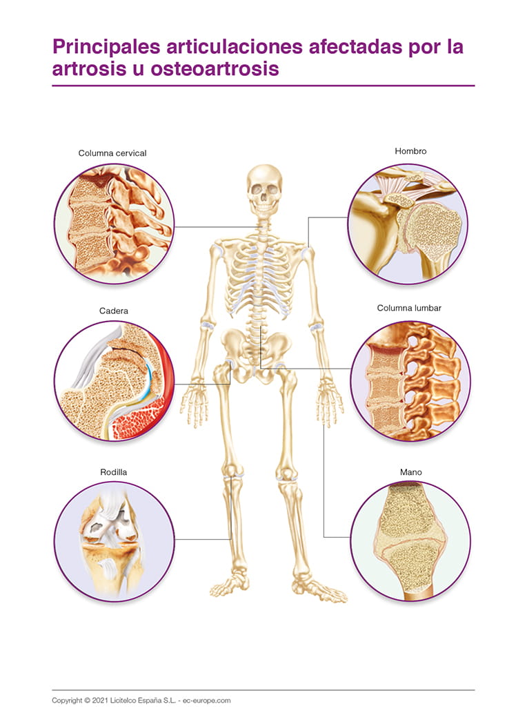 Principales articulaciones afectadas por la artrosis u osteoartrosis
