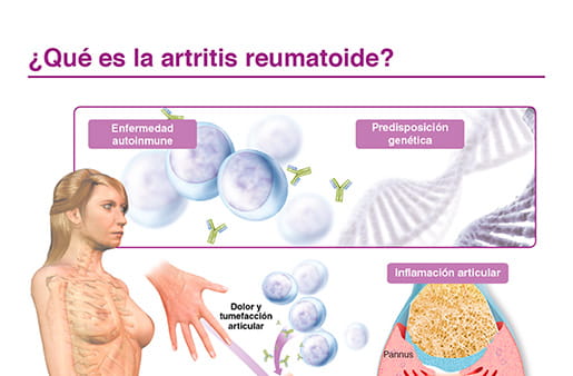 ¿Qué es la artritis reumatoide?