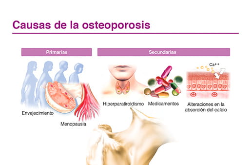 Causas de la osteoporosis