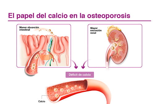 El papel del calcio en la osteoporosis