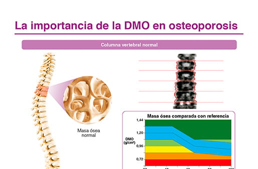 La importancia de la DMO en osteoporosis