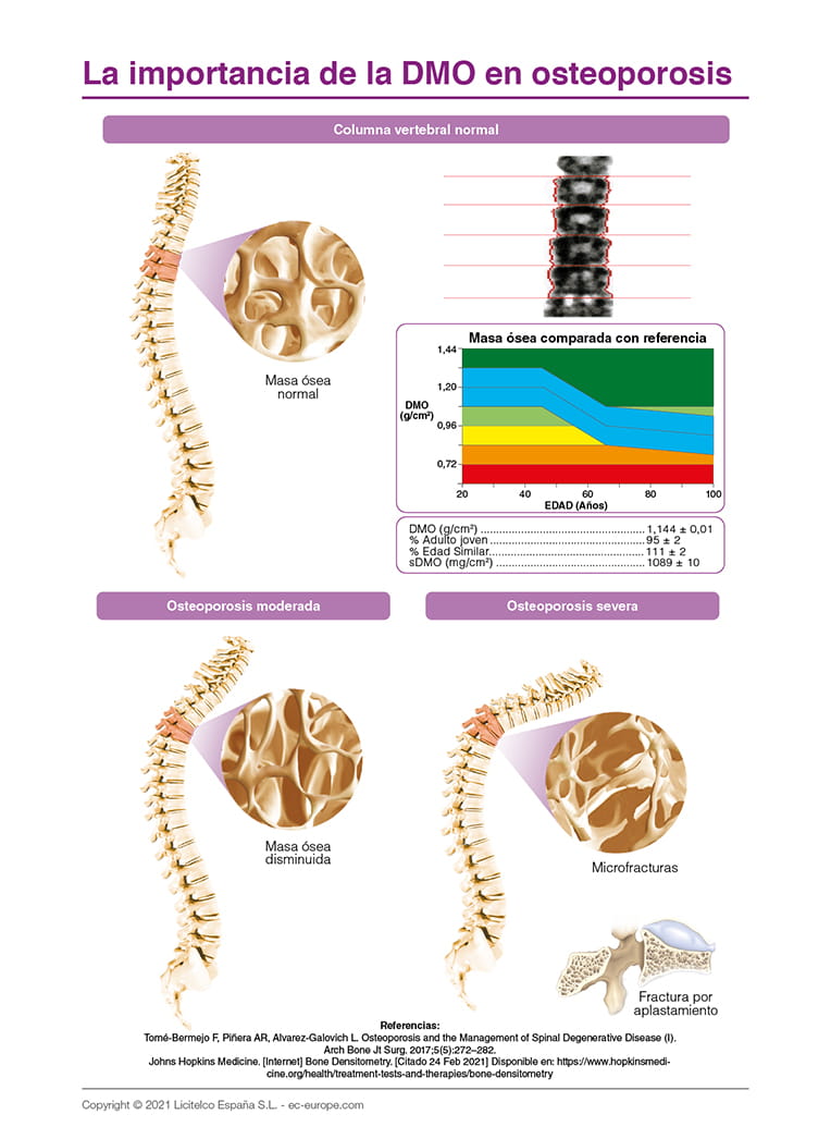 La importancia de la DMO en osteoporosis