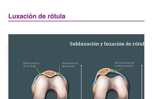 Luxación de rótula