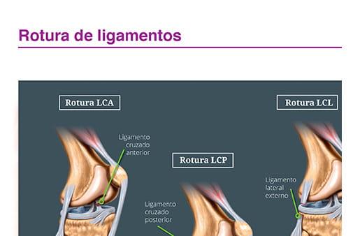 Rotura de ligamentos