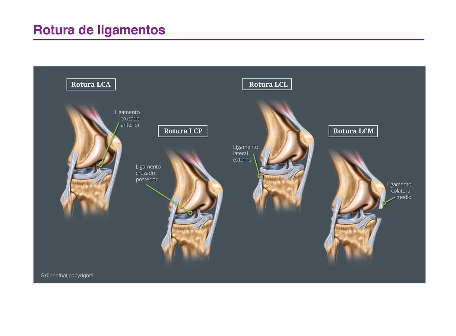Rotura de ligamentos