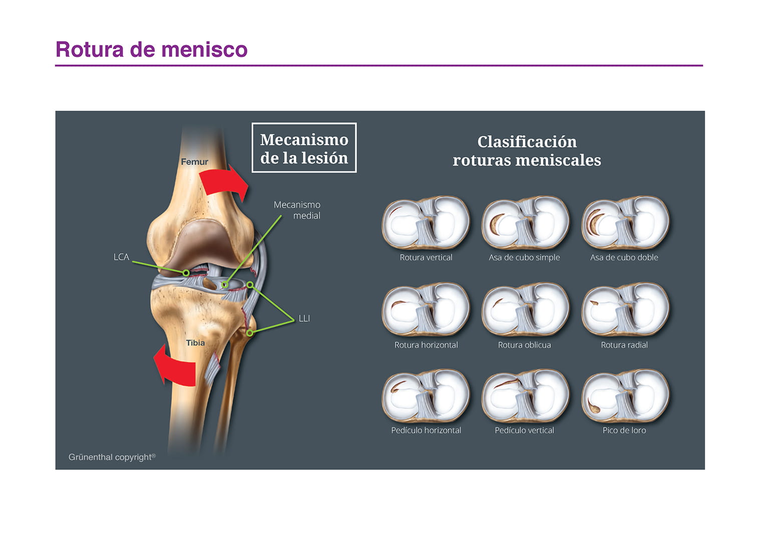 Rotura de menisco