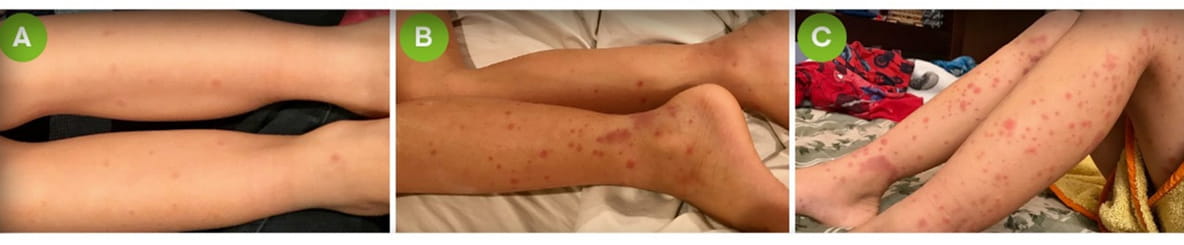 El dolor en las enfermedades raras