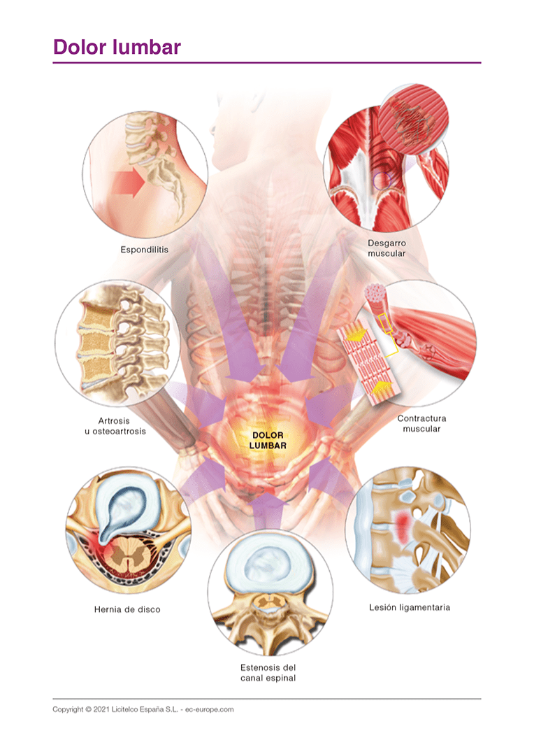 dolor lumbar