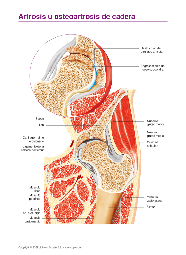 Artrosis cadera