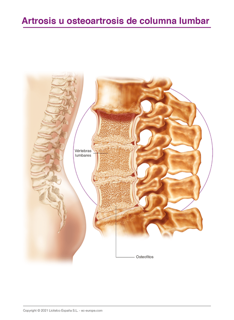 Artrosis lumbar