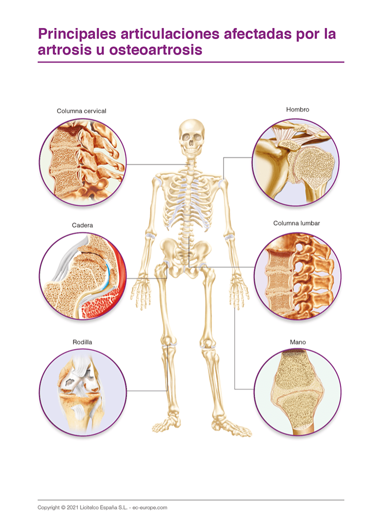 Articulaciones afectadas artrosis