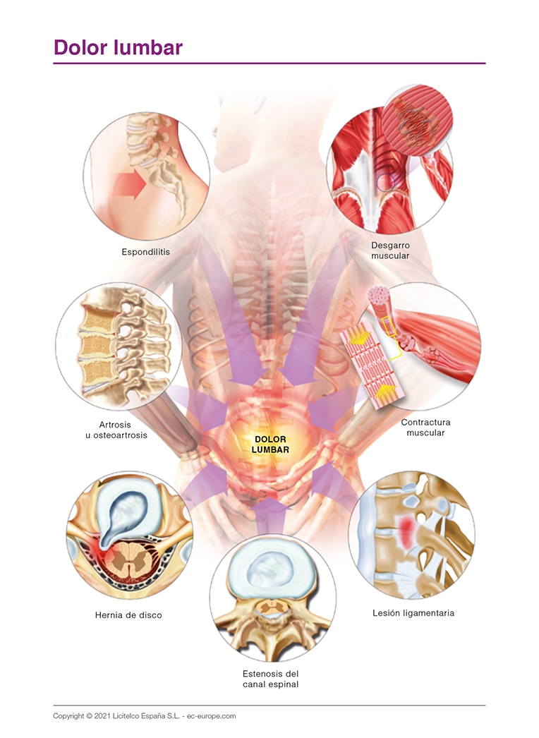 dolor lumbar