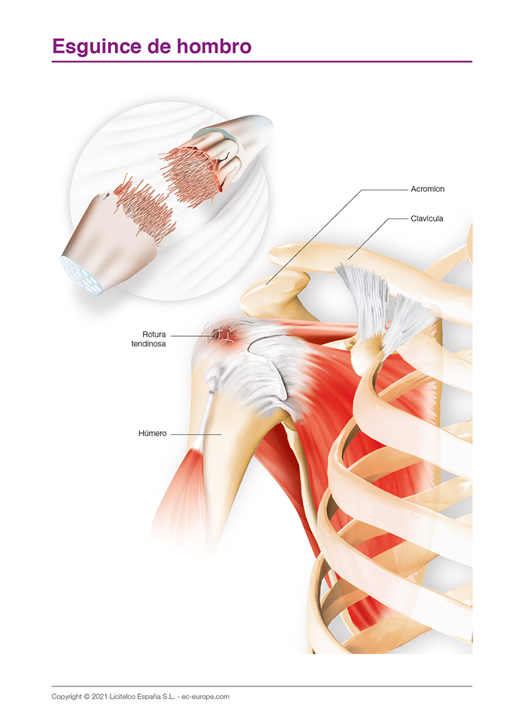 esguince de hombro