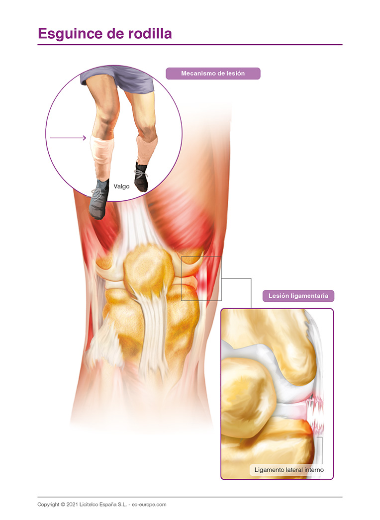 esguince de rodilla