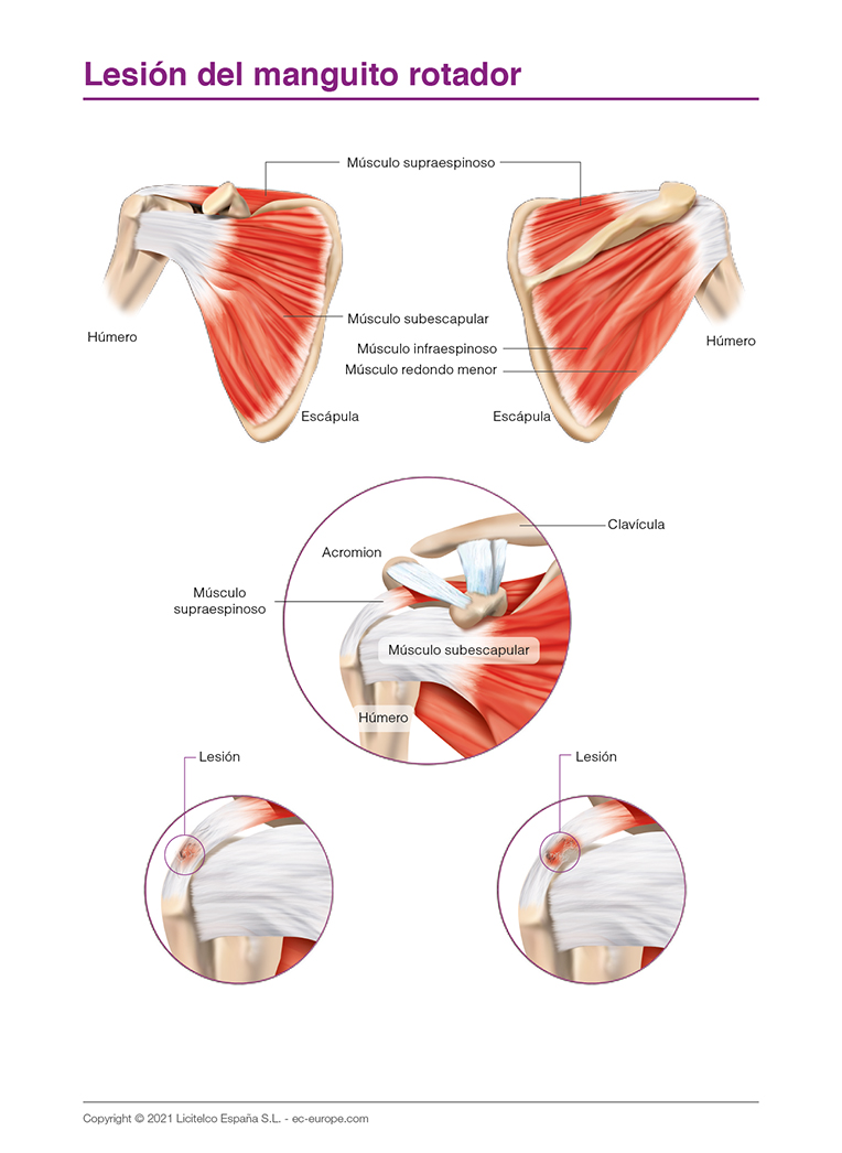 lesión del manguito rotador
