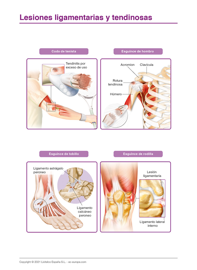 lesiones ligamentarias y tendinosas