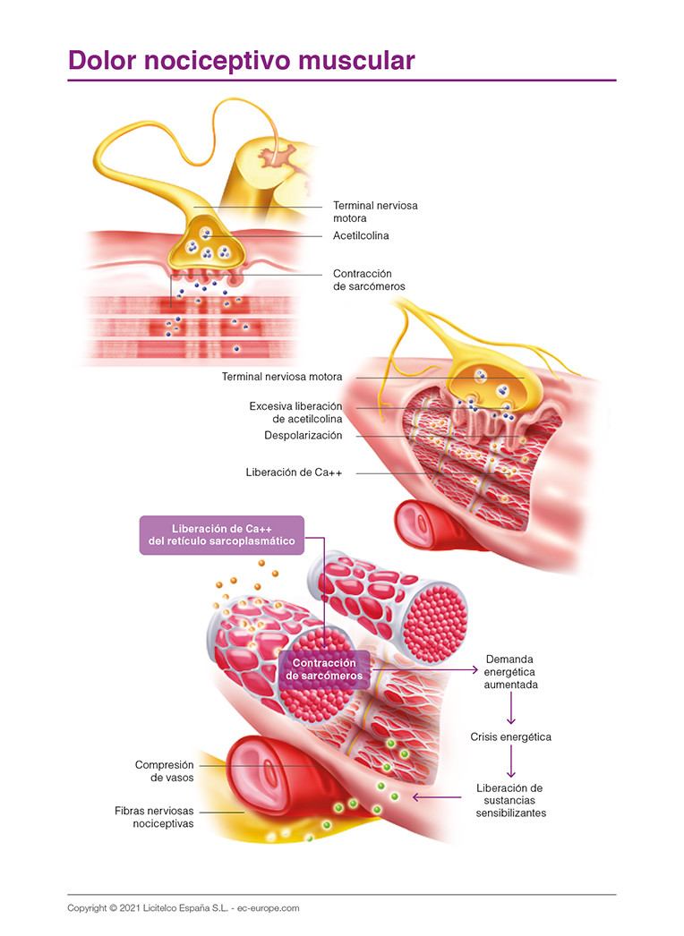 dolor nociceptivo muscular
