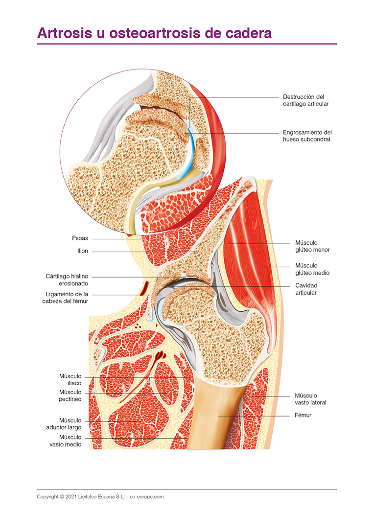 artrosis u osteoartrosis de cadera